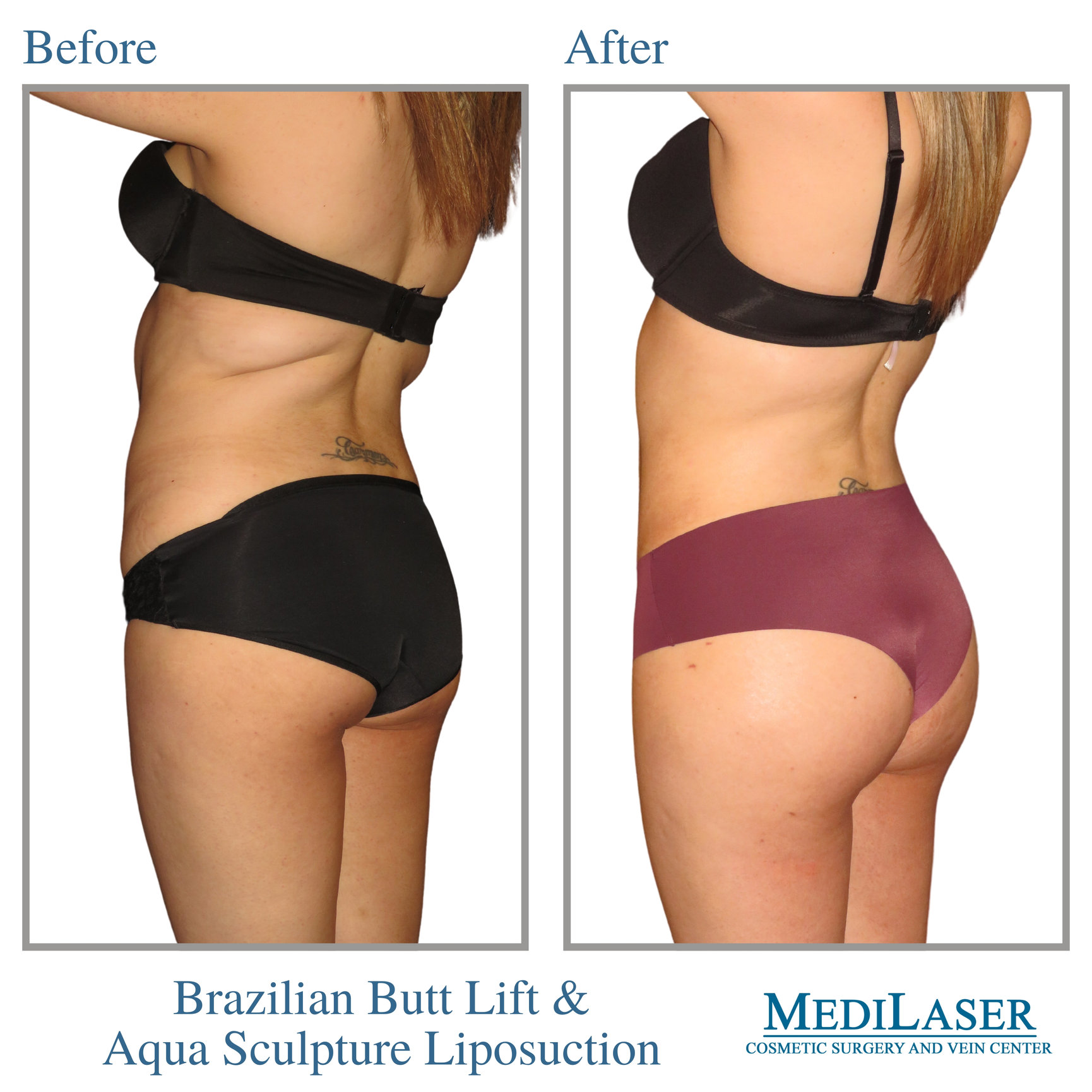 Brazilian Butt Lift Before And After Medilaser Surgery And Vein Center