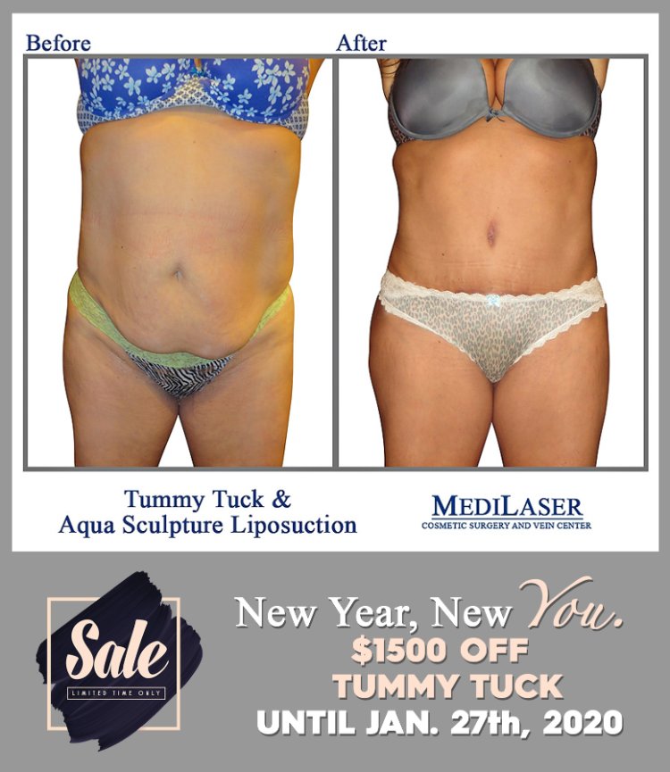 Week Three: Tummy Tuck Sale! - Medilaser Surgery and Vein Center