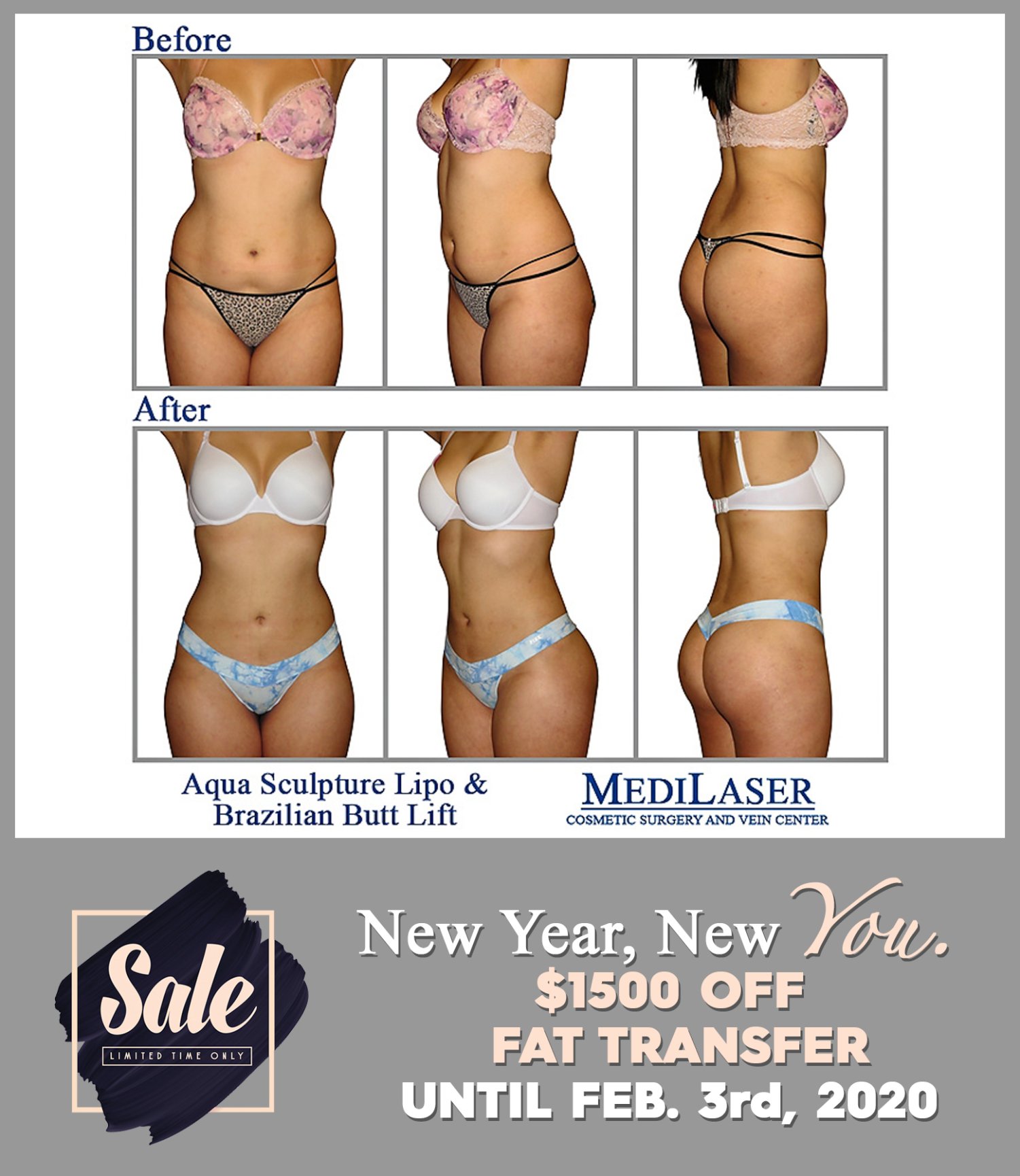 Fat Transfer Amazing Before and After! - Medilaser Surgery and Vein Center
