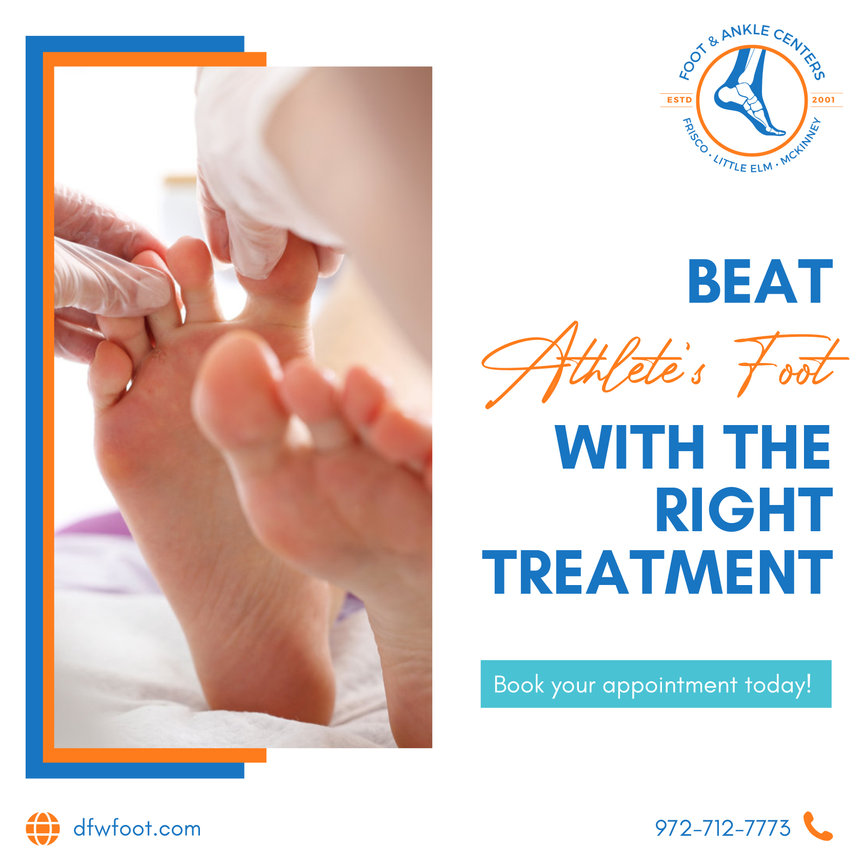 Beat Athlete's Foot With The Right Treatment Foot & Ankle Centers of