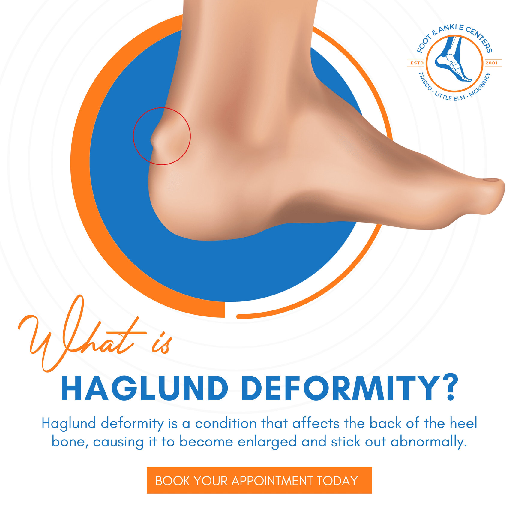 What is Haglund Deformity and Treatment in Frisco, Little Elm, and ...