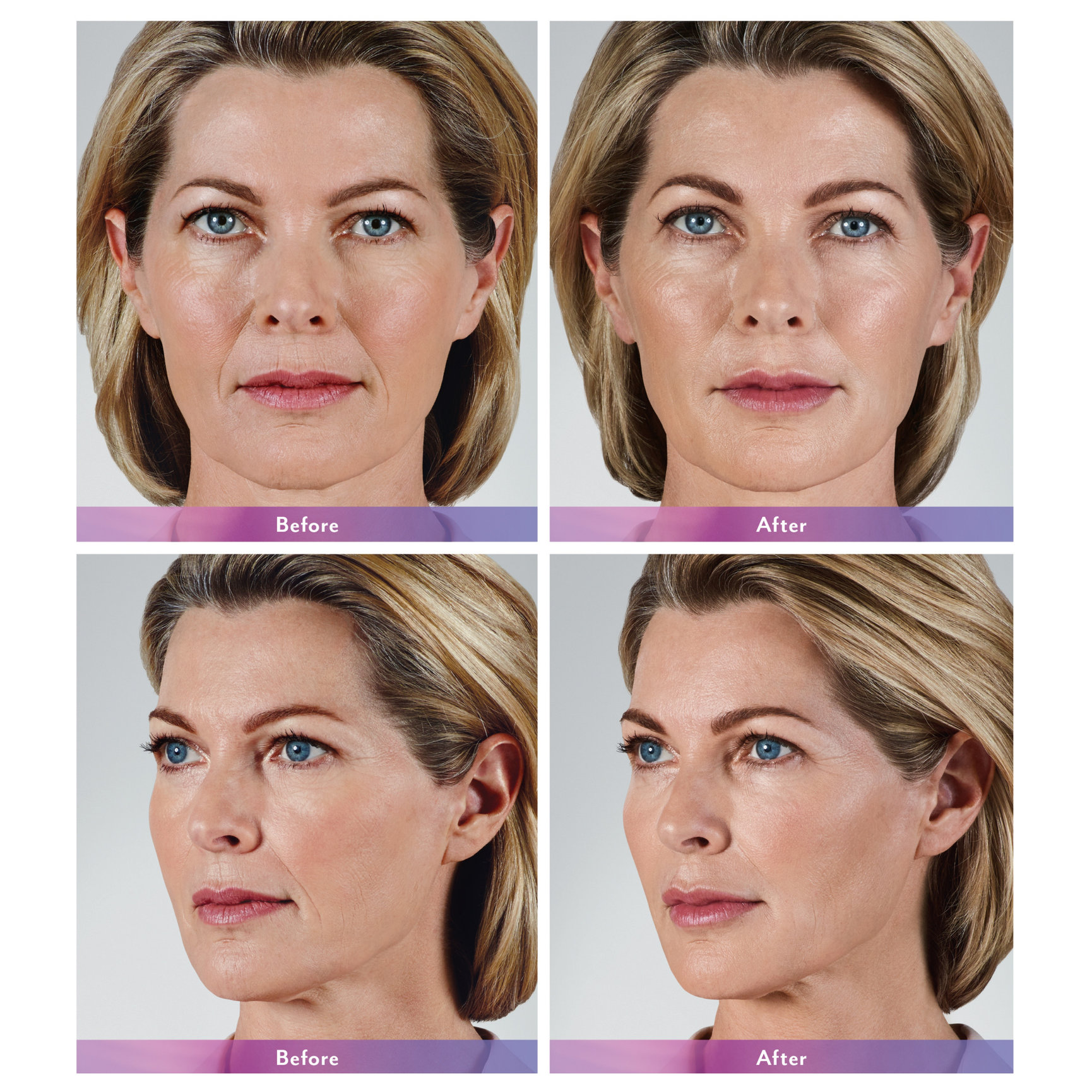 Facial Filler Before And After Feel Ideal 360 Med Spa Southlake Tx 