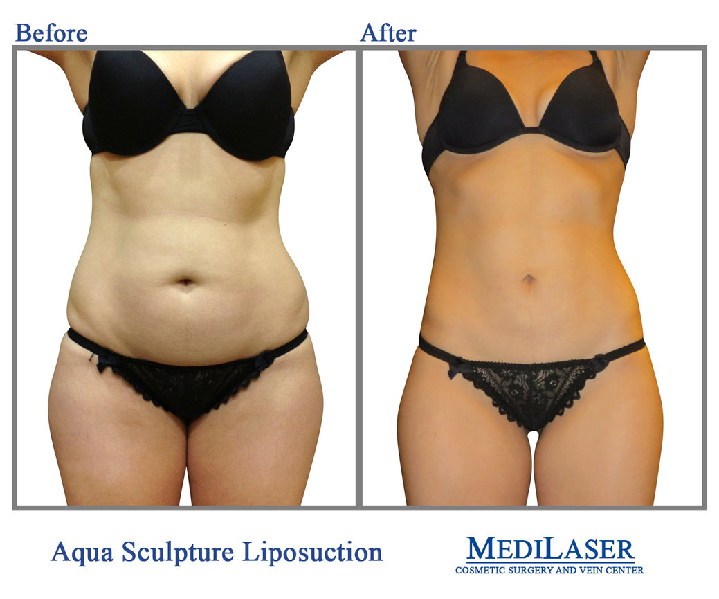 Can You Perform Liposuction On Yourself