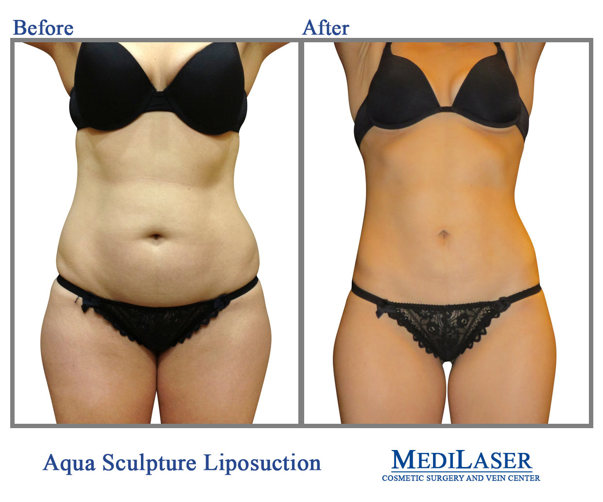 360-Liposuction-Before-And-After - Medilaser Surgery and Vein Center