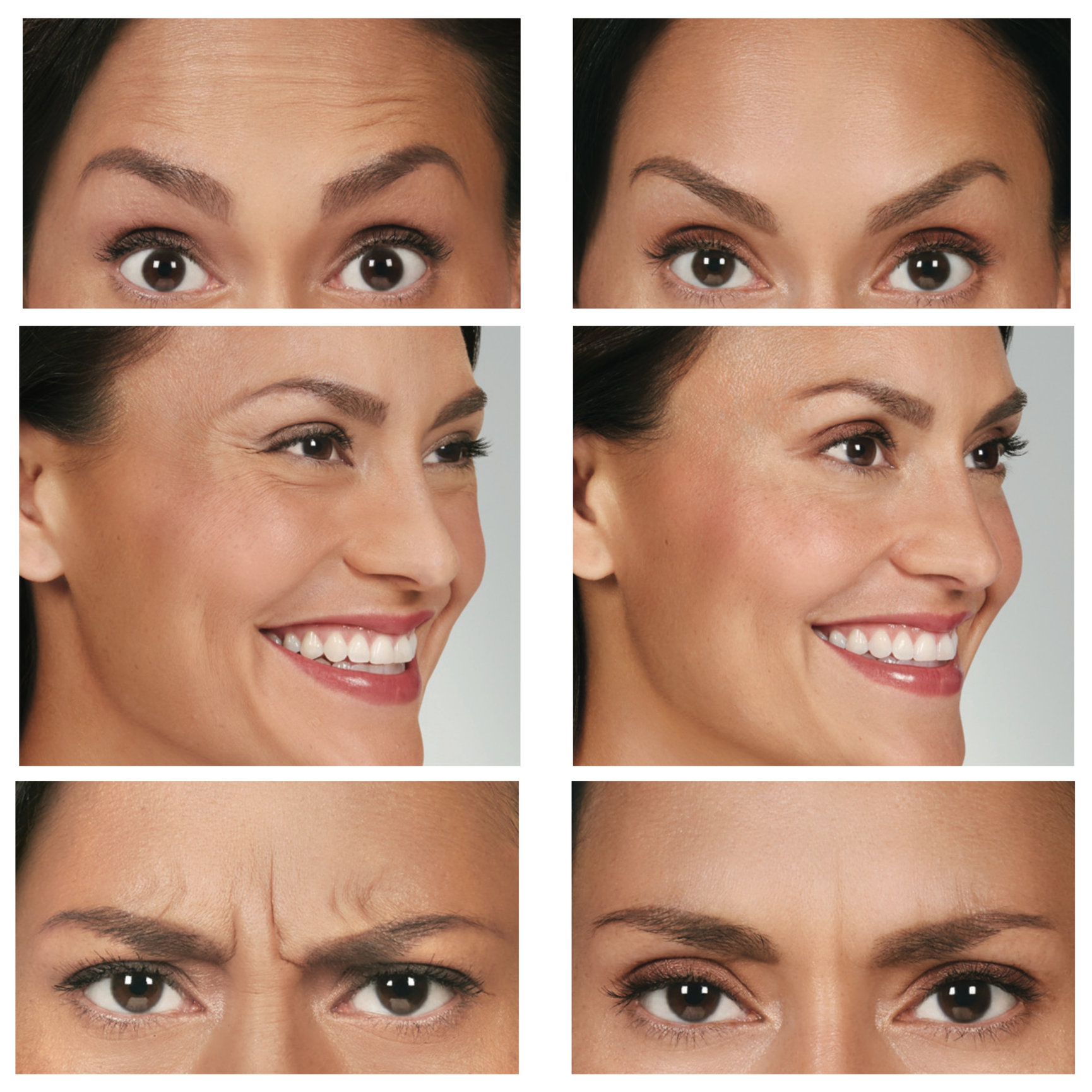 Botox Before And After Feel Ideal 360 Med Spa Southlake Tx