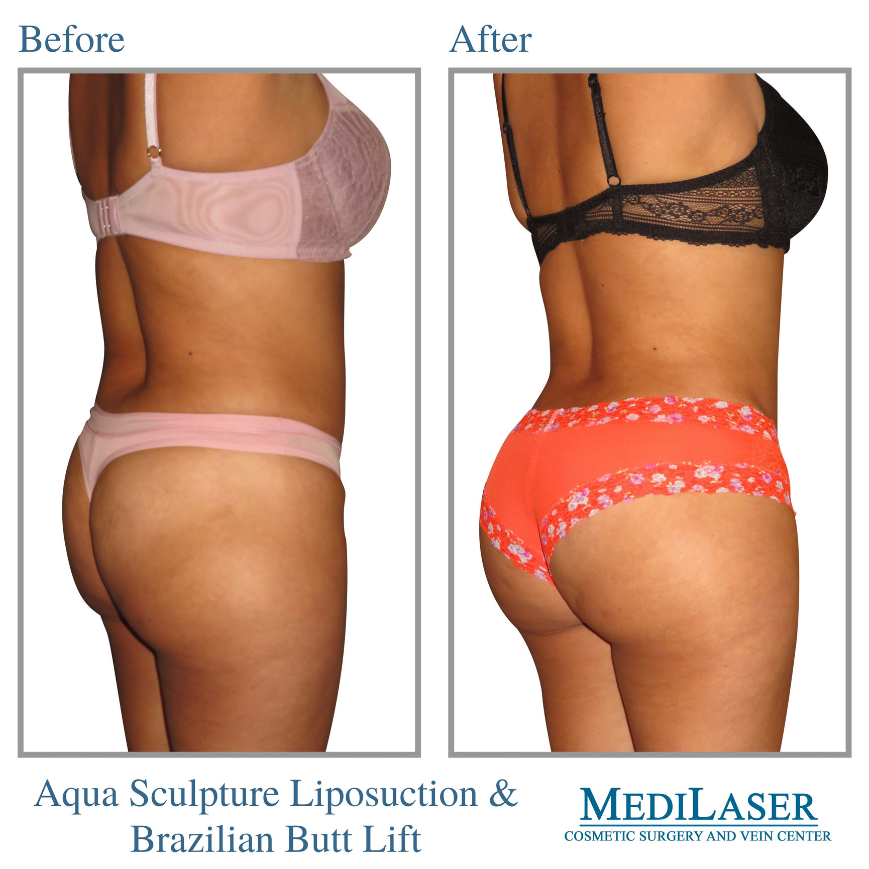 Brazilian-Butt-Lift-Before-After - Medilaser Surgery and Vein Center