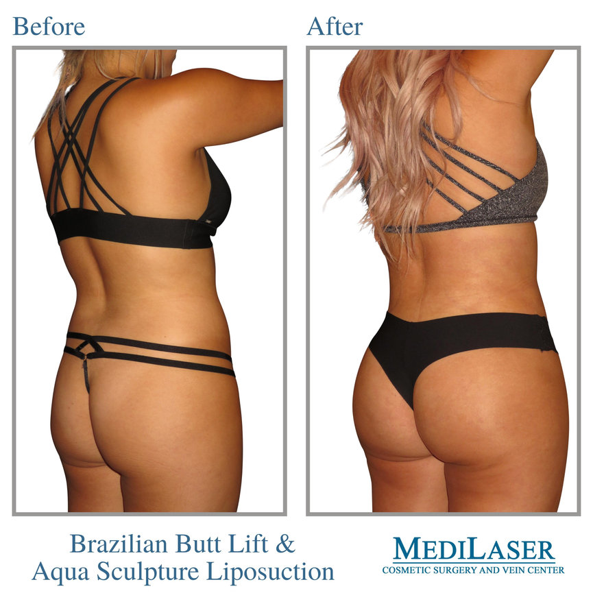 Brazilian Butt Lift Before And After - Medilaser Surgery and Vein Center