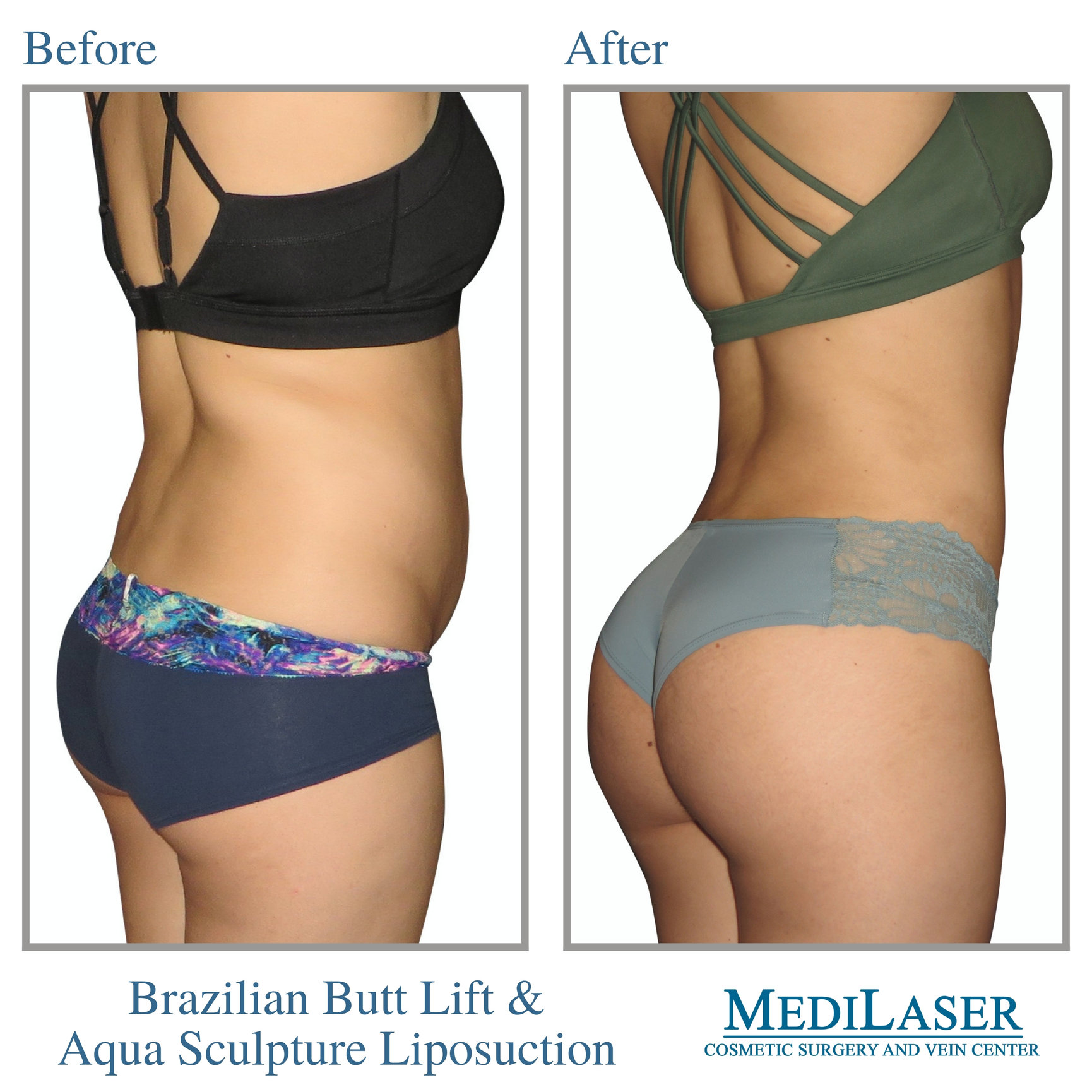 Brazilian Butt Lift Before And After Medilaser Surgery And Vein Center 8338