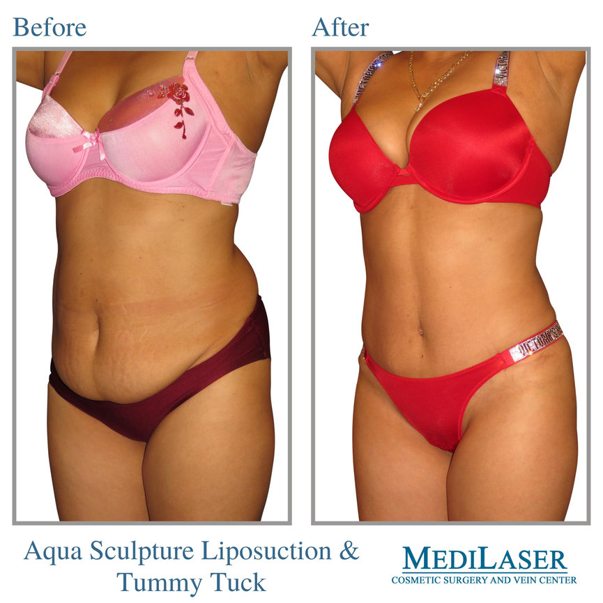 Tummy Tuck And Liposuction Before And After Frisco Texas Medilaser Surgery And Vein Center
