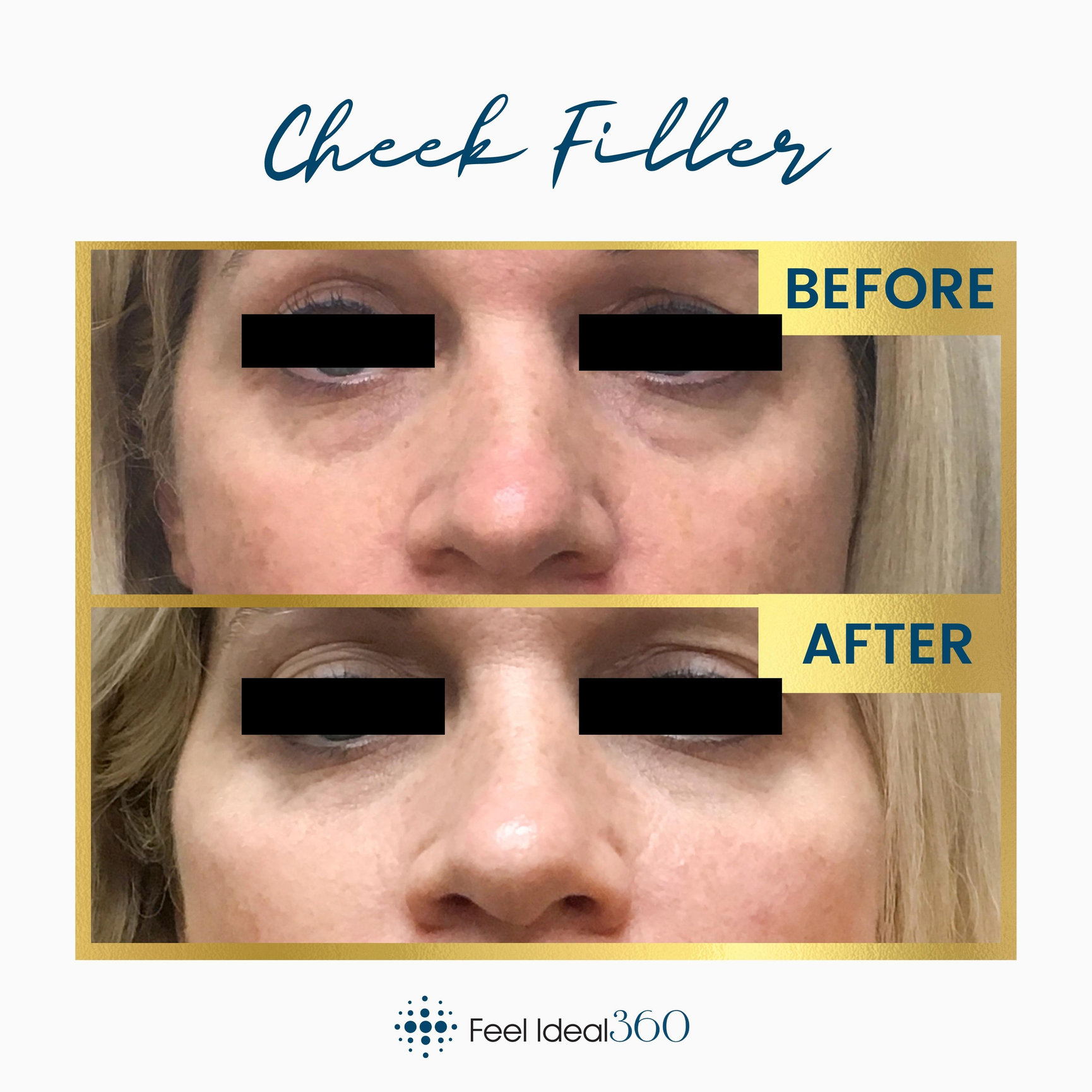 Facial Filler Before and After - Feel Ideal 360 Med Spa - Southlake, TX