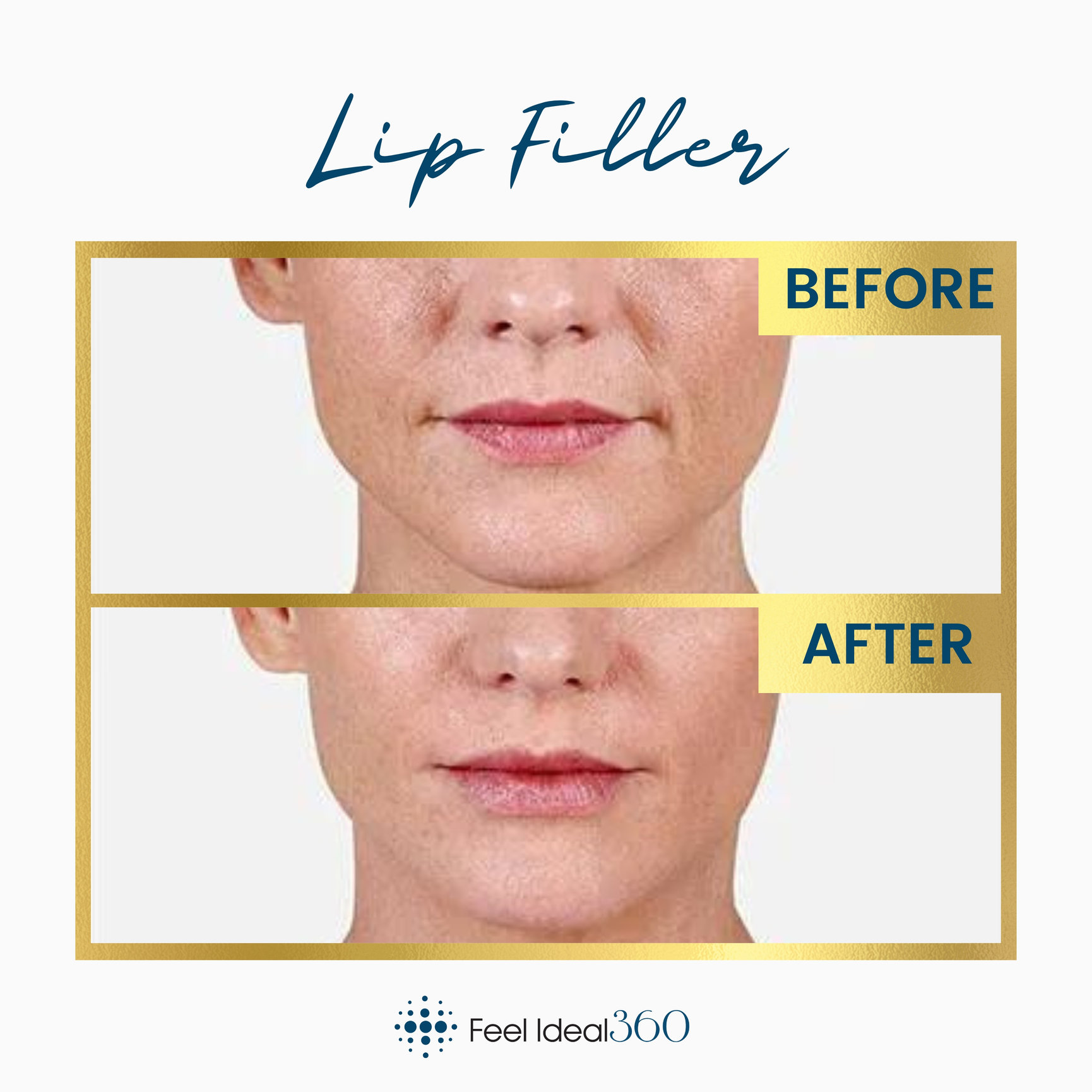 Check Out This Before And After Of Our Lip Filler Service At Feel Ideal